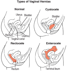vag-hern